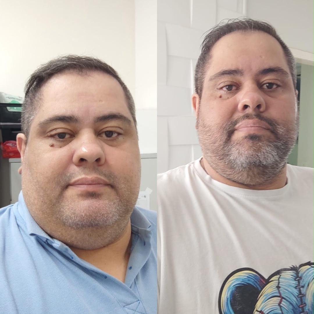 Evolução de paciente — antes e depois